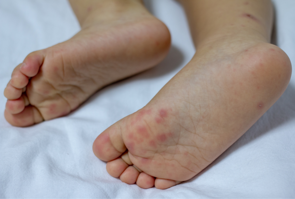 Seremi de Salud llama a la prevención ante aumento de brotes de síndrome boca, mano, pie