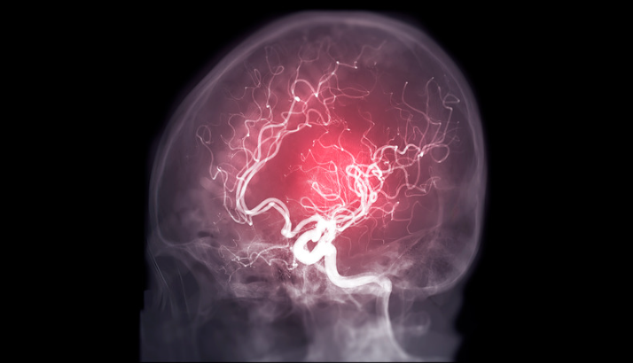 La detección temprana del infarto cerebrovascular: Clave para salvar vidas