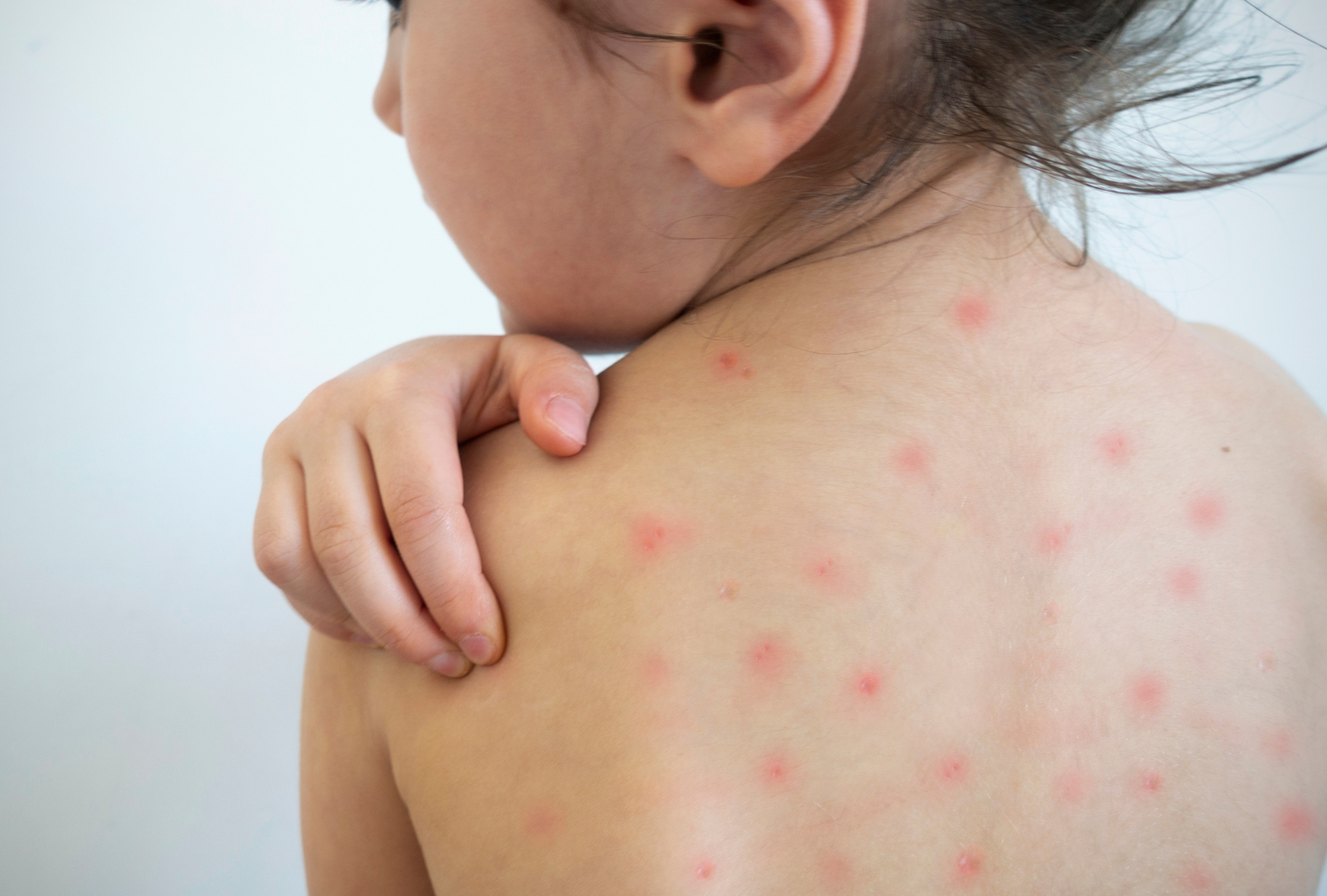 Refuerzan la prevención de cuadros de Varicela en establecimientos educacionales