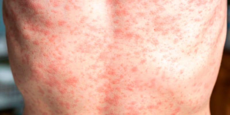 Realizan llamado a personas nacidas entre 1971 y 1981 a vacunarse contra el Sarampión