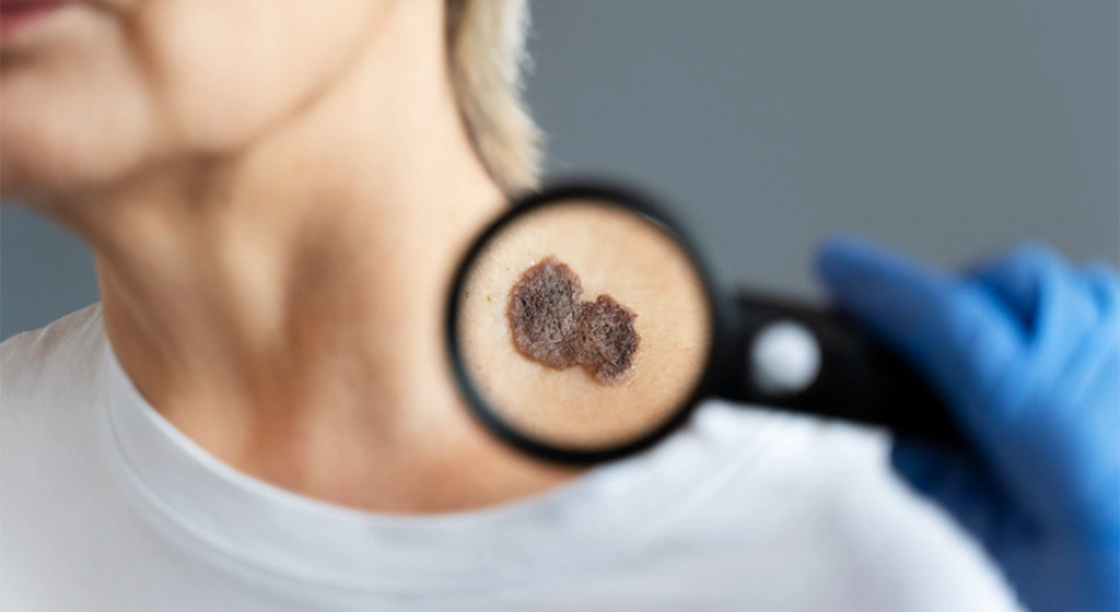 Cáncer de piel: señales de alerta que no se deben ignorar