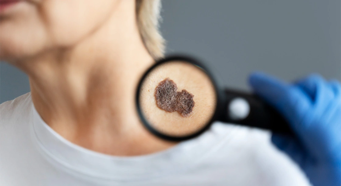 Cáncer de piel: señales de alerta que no se deben ignorar